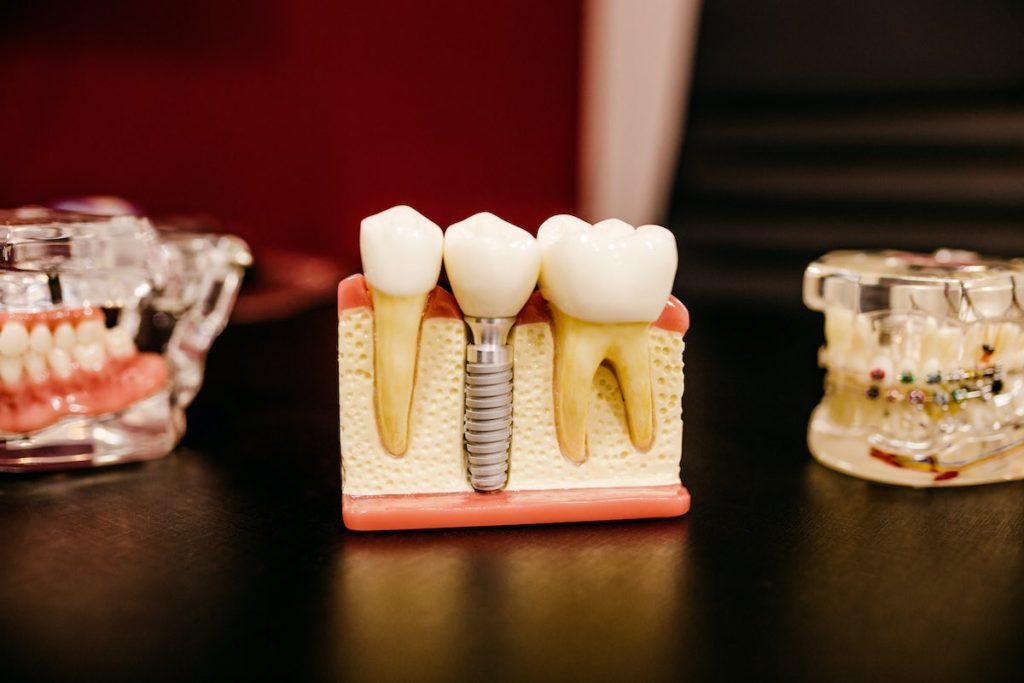 A model showing a single tooth dental implant.