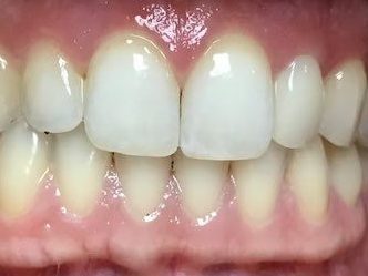  after dental veneers photo from montavilla dental arts, a dentist in portland oregon
