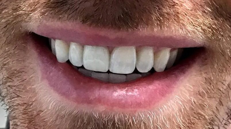 after photo of dental veneers at montavilla dental arts, a dentist in portland oregon
